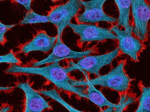 Cellules HeLa immortelles au microscope — rendues immortelles par le virus HPV-18 qui a causé la mort d'Henrietta Lacks