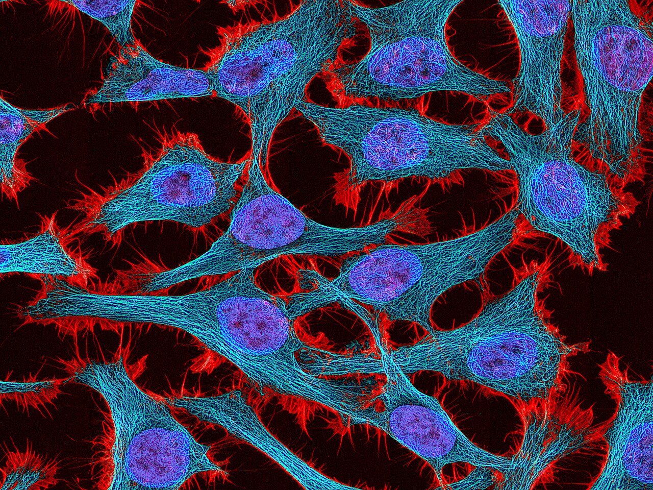 Cellules HeLa immortelles au microscope — rendues immortelles par le virus HPV-18 qui a causé la mort d'Henrietta Lacks